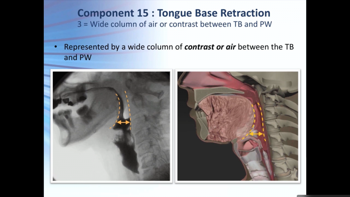MBSImP Training - Component 15 - Tongue Base Retraction