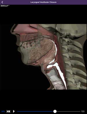 Animation of impairment of laryngeal vestibular closure.
