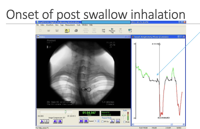 DIEZ Esophageal Therapy