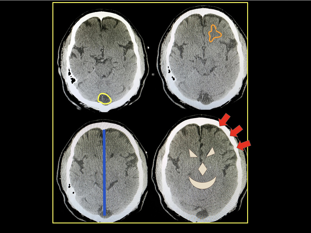 Head and Neck Cancer - Speech Pathology Training