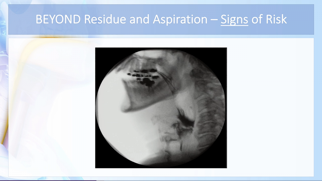 MBSImP Dysphagia Treatment - Aspiration