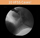 VFSS Child