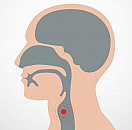 Total Laryngectomy