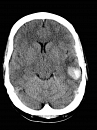 Neuroimaging