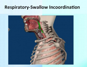 Dysphagia: Integrating Respiration And Deglutition