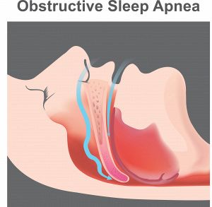 Dysphagia in Obstructive Sleep Apnea (OSA) – An Under-Recognized Impairment