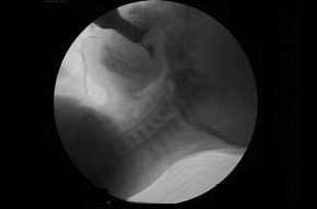 Pediatric Dysphagia: Interpretation of VFSS, Management and Treatment Planning