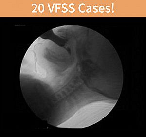 Pediatric Dysphagia: Interpretation Of VFSS, Management And Treatment Planning