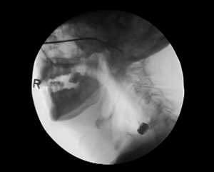 Dysphagia Intervention for the Esophageal Zone (DIEZ): A therapeutic respiratory technique for non-pathologic esophageal stasis and globus.