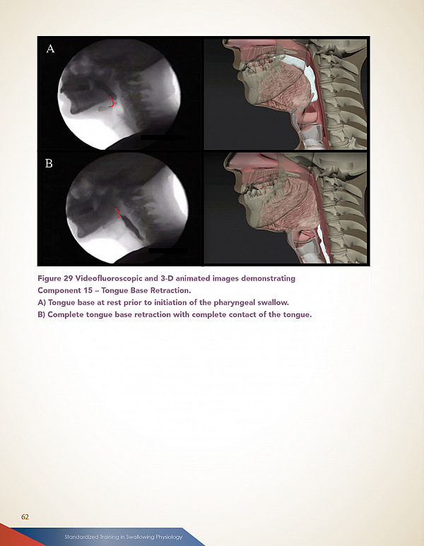 Tongue Base Retraction Images