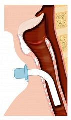 Problem Solving Tracheostomy Tubes For The Speech-Language Pathologist