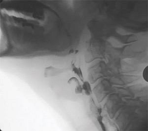 The Penetration-Aspiration Scale: Standardizing Airway Protection Judgments From MBS Studies