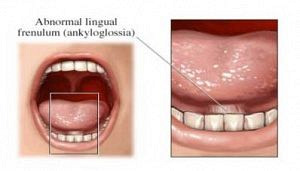 Tongue Tie 101 For SLPs: What Is Our Role?